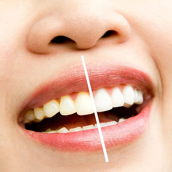 Woman teeth whitening treatment